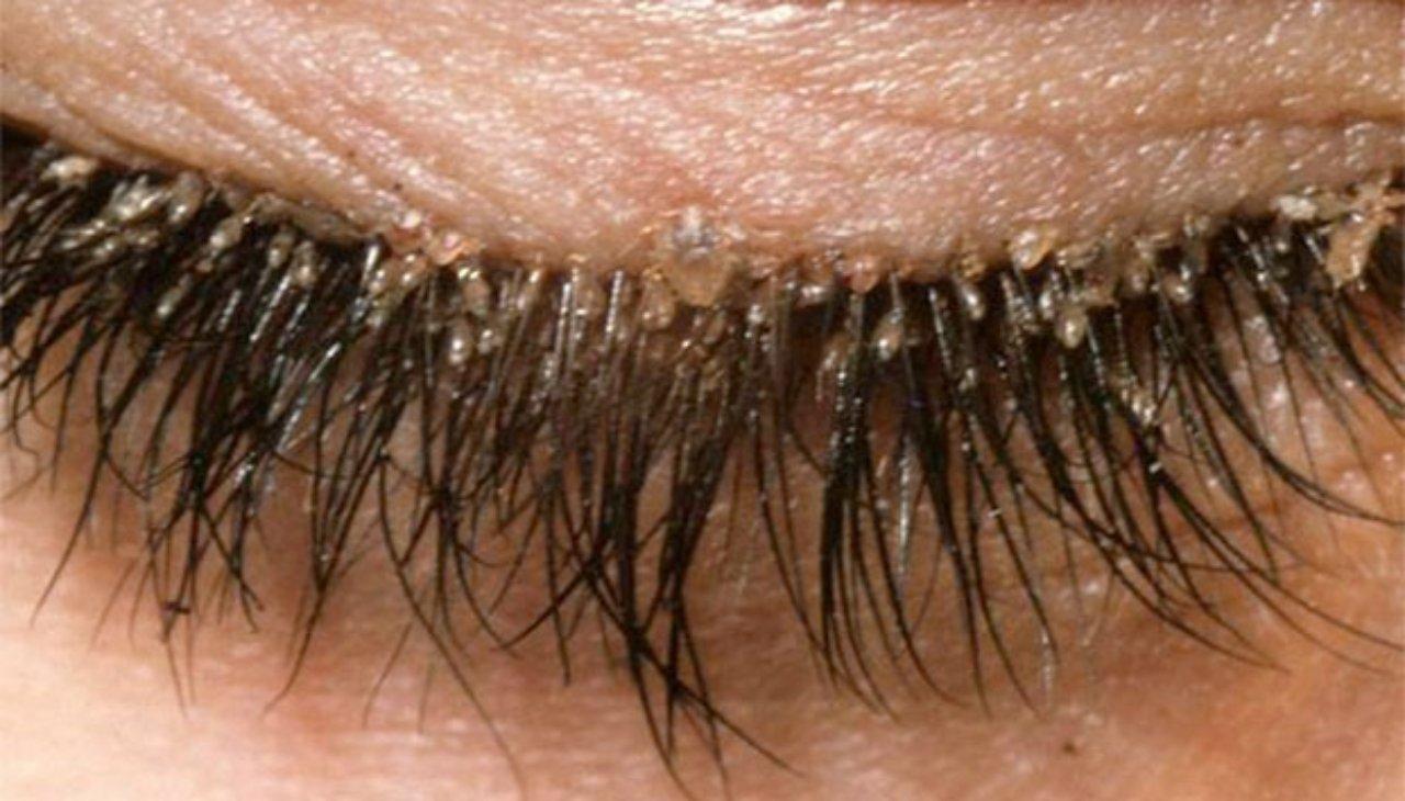 Imagen de Advierten a hondureñas  sobre riesgo de presentar piojos en extensiones de pestañas