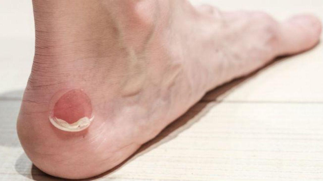 Imagen de 6 remedios caseros que ayudan a curar las ampollas en los pies