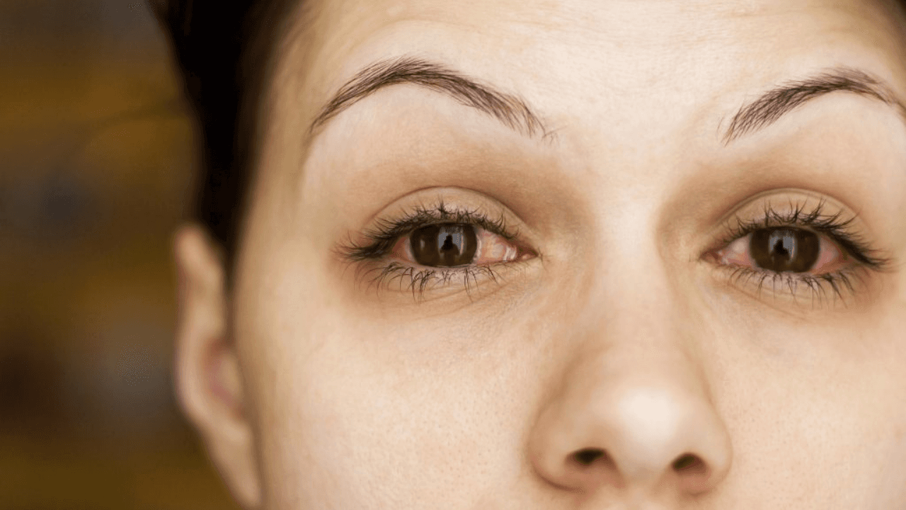 Imagen de Conoce los remedios para aliviar la conjuntivitis