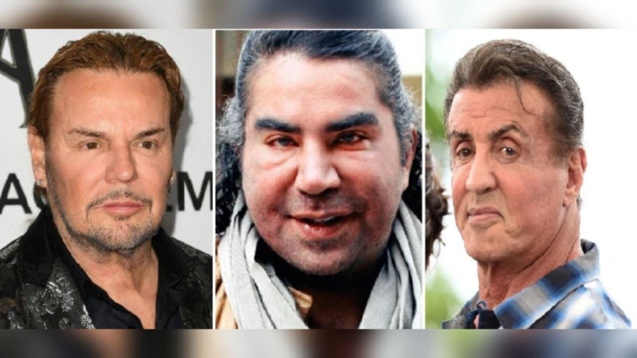 Imagen de ¡Fotos! Los hombres famosos que se sometieron a cirugías y arruinaron su rostro