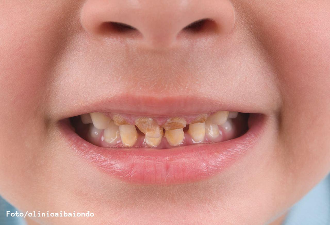 Imagen Principal de Nota: Experto hondureño explica los 4 síntomas que alertan la aparición de caries infantil