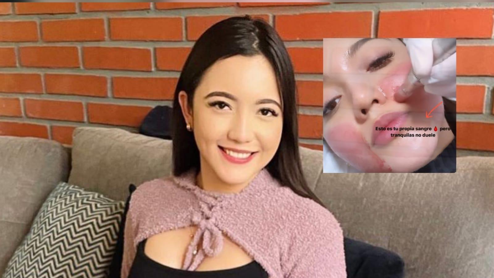 Imagen Principal de Nota: Carla Cubas sorprende a seguidores al someterse a tratamiento facial con su propia sangre
