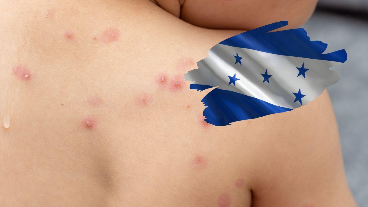 Imagen de Salud confirma tercer caso de viruela del mono en Honduras
