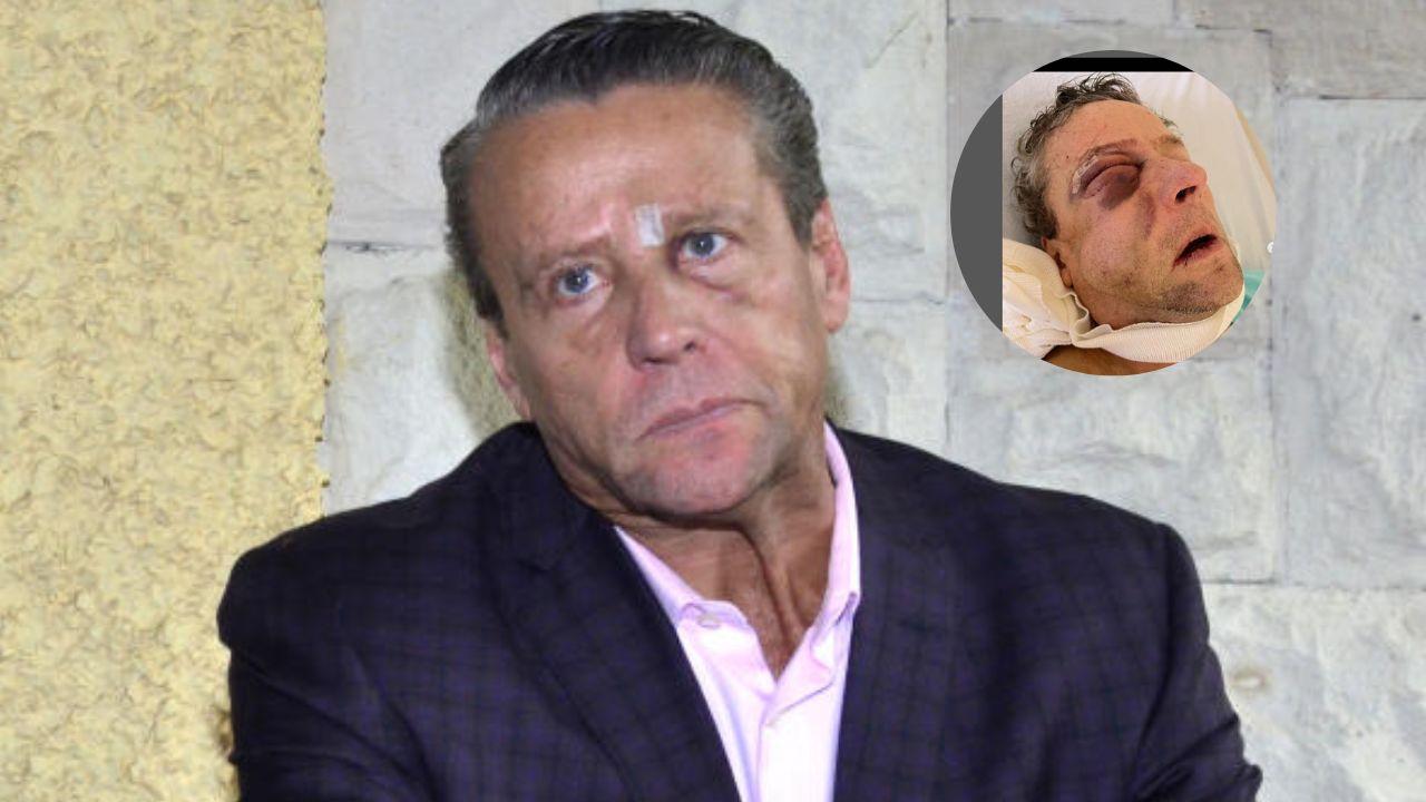 Imagen de Alfredo Aldame comparte impactantes imágenes tras ser golpeado brutalmente por vecino