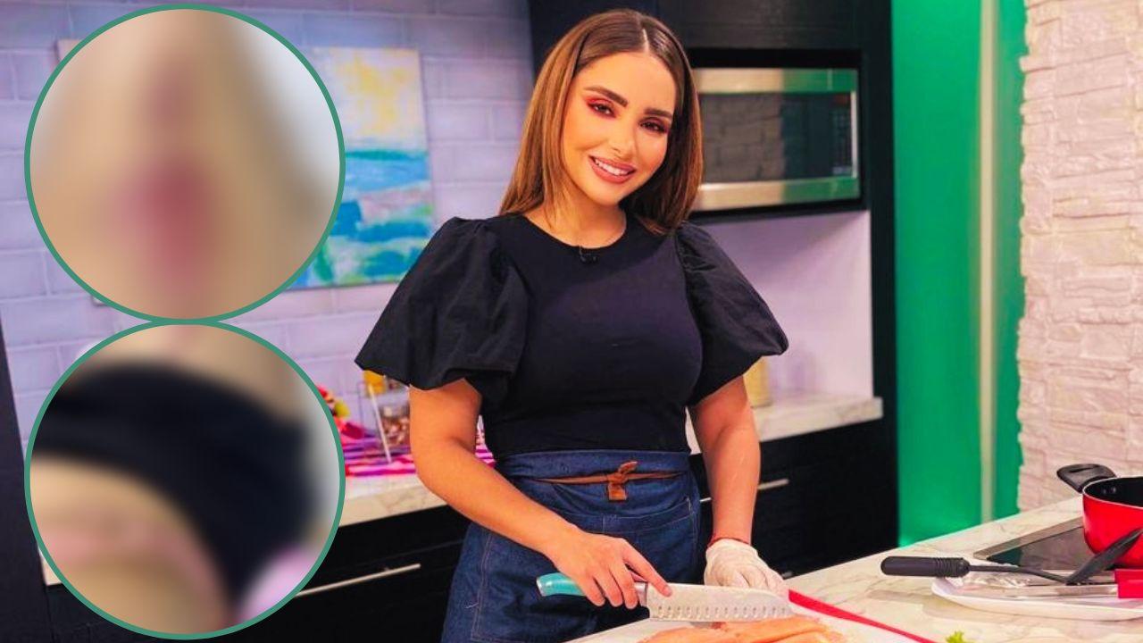 Imagen de Laura Pérez muestra las quemaduras que sufrió a inicios del 2023