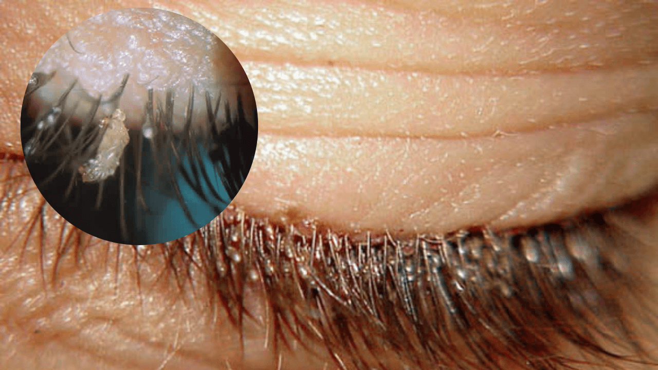 Imagen de Aparición de piojos en pestañas postizas alerta a médicos; en Honduras hay casos