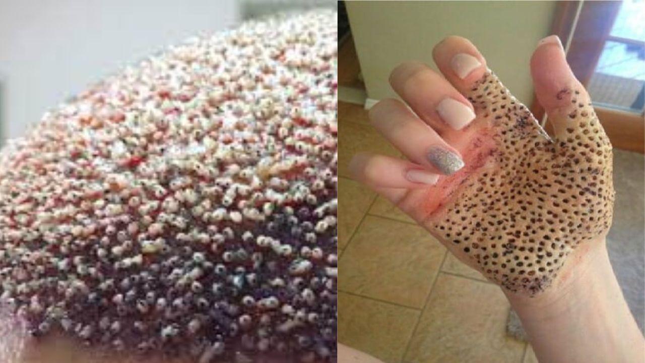 Imagen de ¿Qué es la tripofobia? ¿Afecta la piel? Aquí sus causas y síntomas