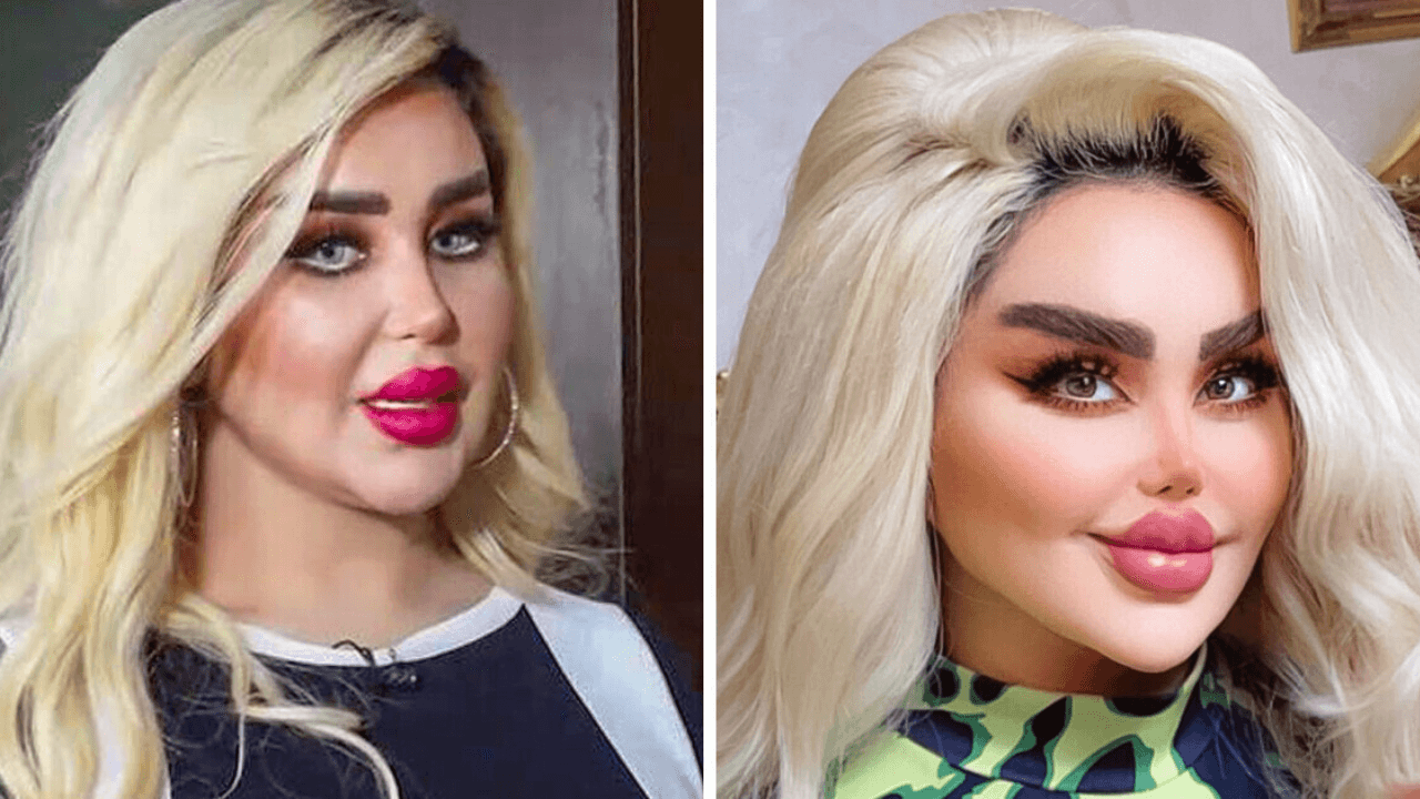 Imagen de ¡Obsesión por ser Barbie! Actriz lleva 43 cirugías para parecer muñeca