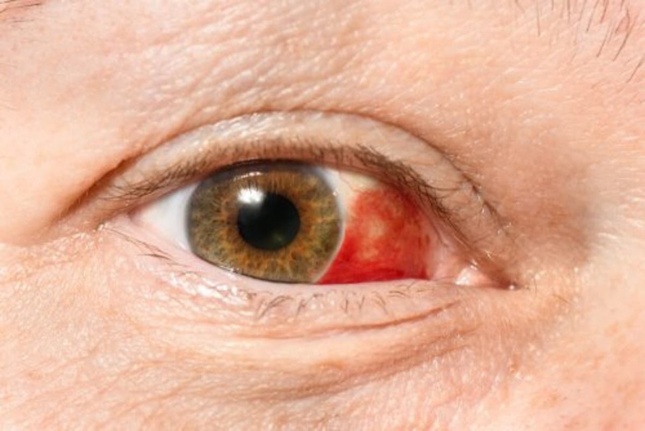 Imagen de ¡Ten cuidado! Estas son las principales causas por las que surgen los derrames oculares