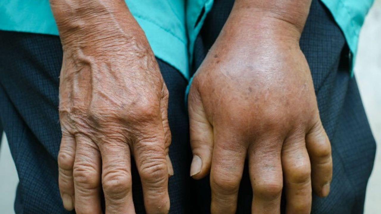 Imagen de Conozca las razones por las que se hinchan los dedos de las manos
