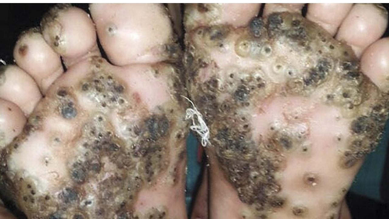 Imagen de Niguas, las peligrosas pulgas que te depositan huevos en los pies