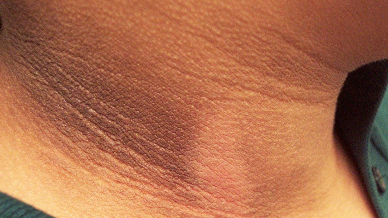 Imagen Principal de Nota: ¿Por qué salen las manchas oscuras en el cuello?