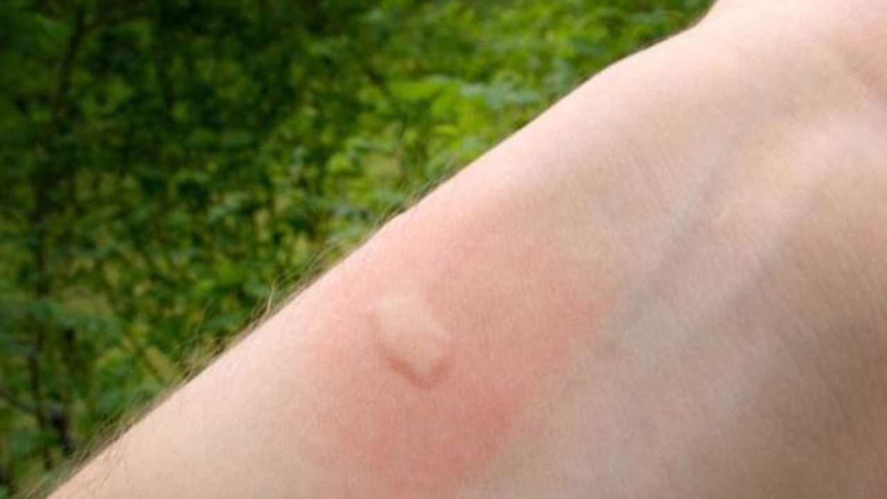 Imagen de ¿Te has preguntado por qué aparece una roncha tras ser picado por un mosquito? Aquí la respuesta