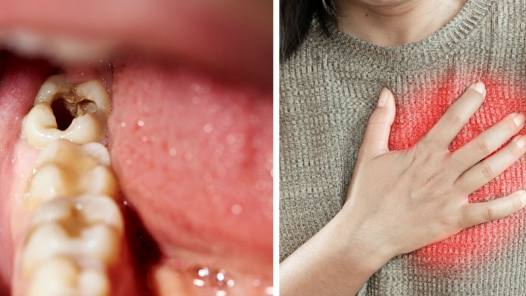 Imagen Principal de Nota: Las caries pueden provocar enfermedades graves en el corazón y en los pulmones, esto es lo que debes saber