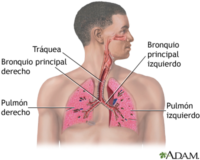 La neumonía es la infección del pulmón por bacterias como el neumococo Streptococcus pneumoniae o el virus de la gripe como los de la influenza tipo A y tipo B.