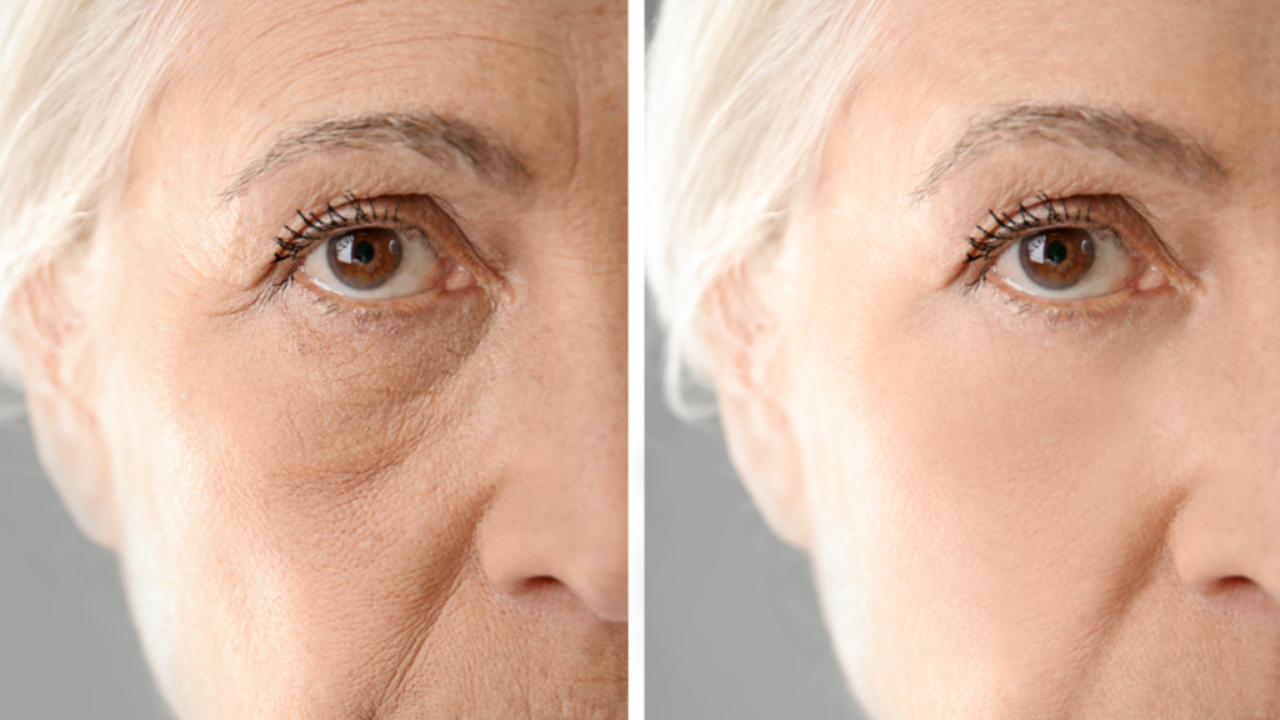 Imagen de Las Mañanas del 5: ¿En qué consiste el lifting o rejuvenecimiento facial?