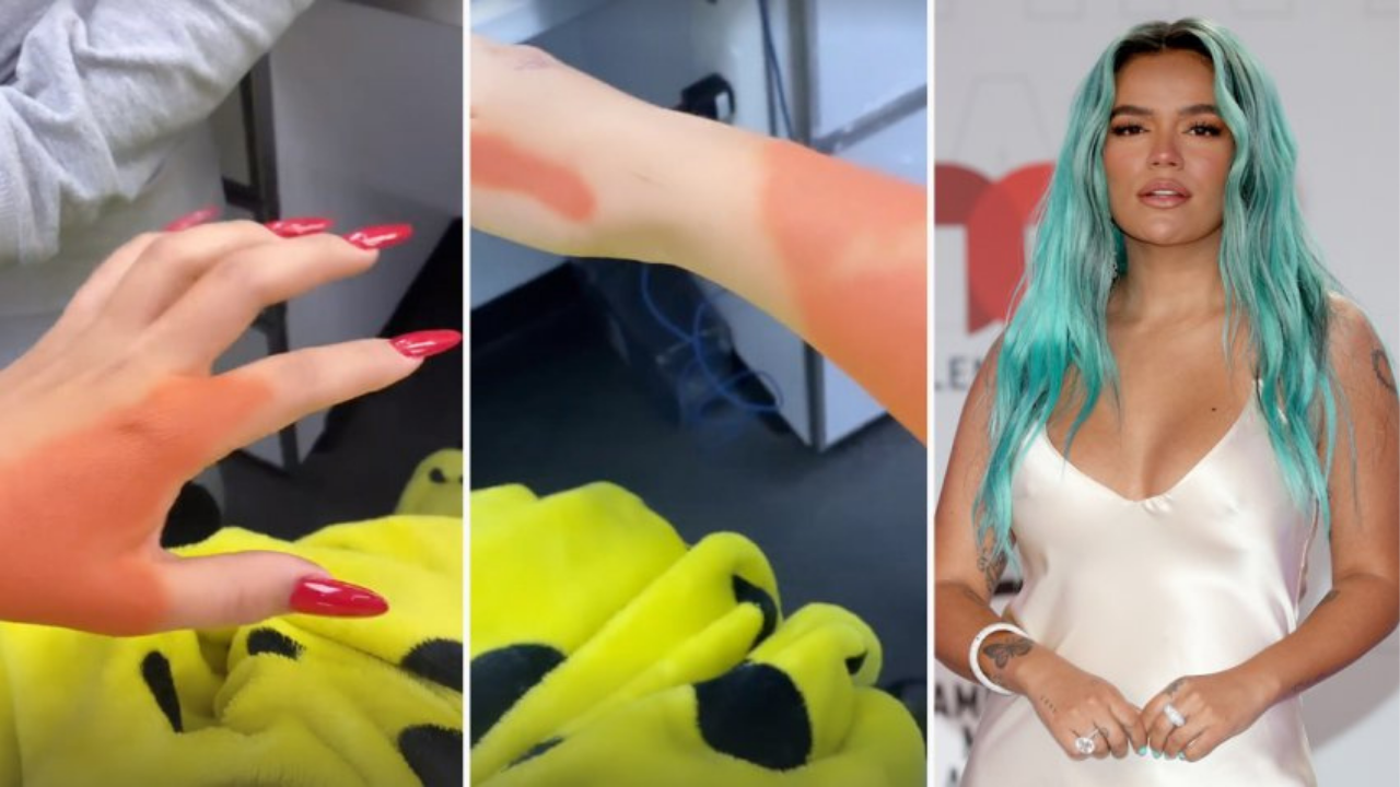 Imagen Principal de Nota: ¿En venganza? Karol G también borra sus tatuajes de Anuel AA y así muestra el proceso