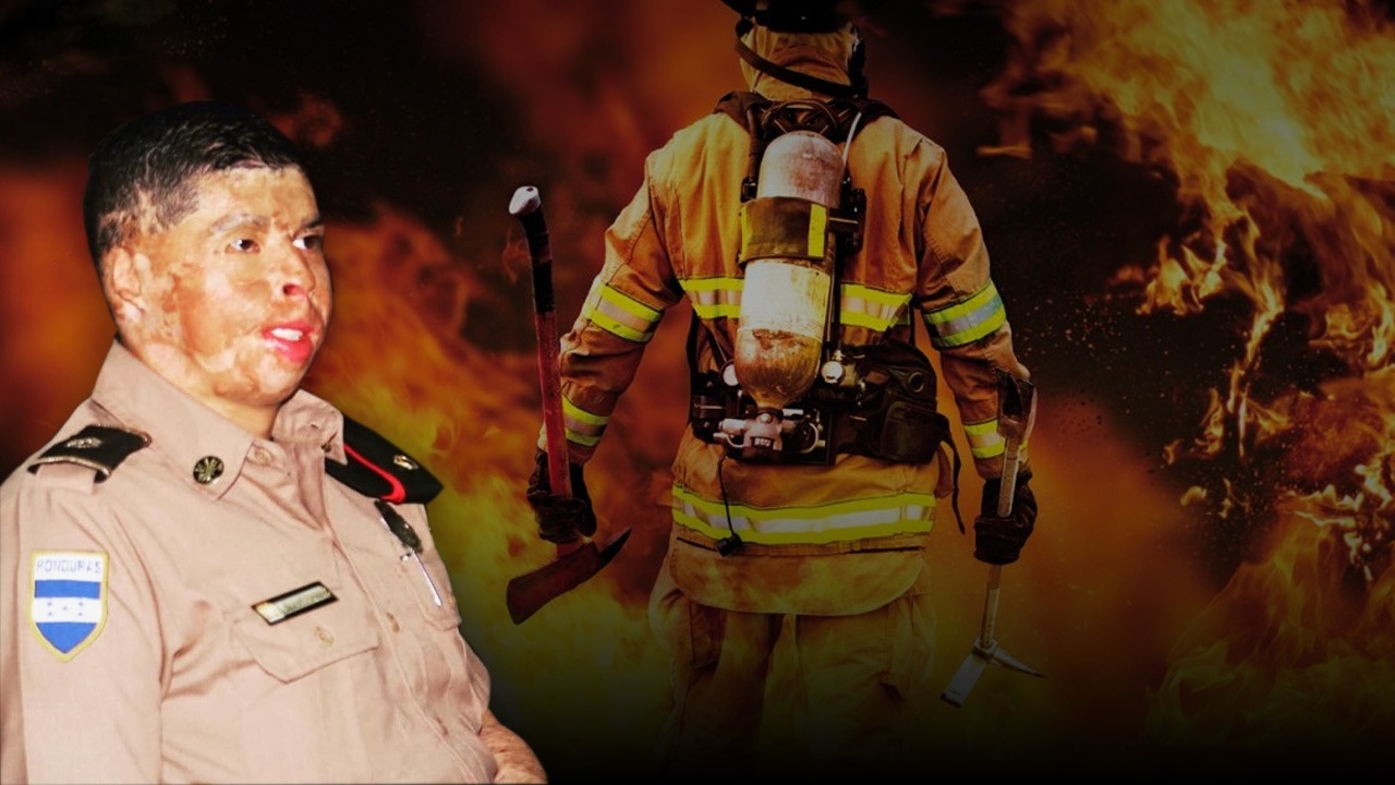 Imagen de El bombero hondureño Ever Velásquez recuerda con nostalgia otro año del incendio que le desfiguró su rostro