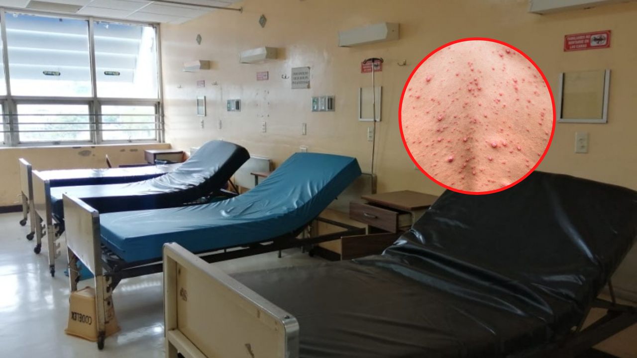 Imagen Principal de Nota: ¿En qué hospitales del Distrito Central atenderán pacientes con viruela del mono?