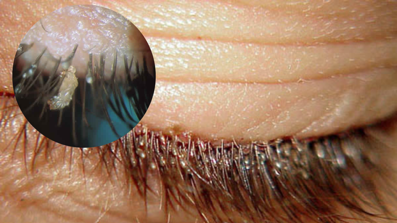 Imagen de Aparición de piojos en pestañas postizas alerta a médicos; en Honduras hay casos
