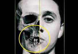 Mandíbula de Canserbero fracturada: la imagen que permitió conocer la verdad - LaKalle