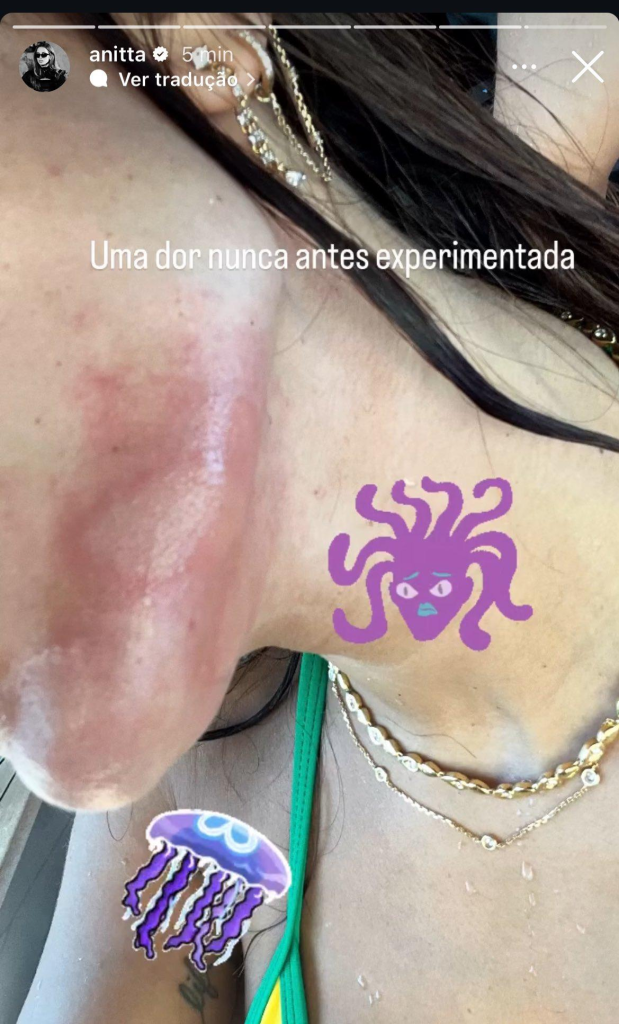 Anitta accidente medusa Ibiza