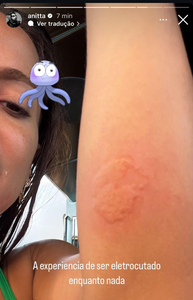 Anitta quemada por medusa