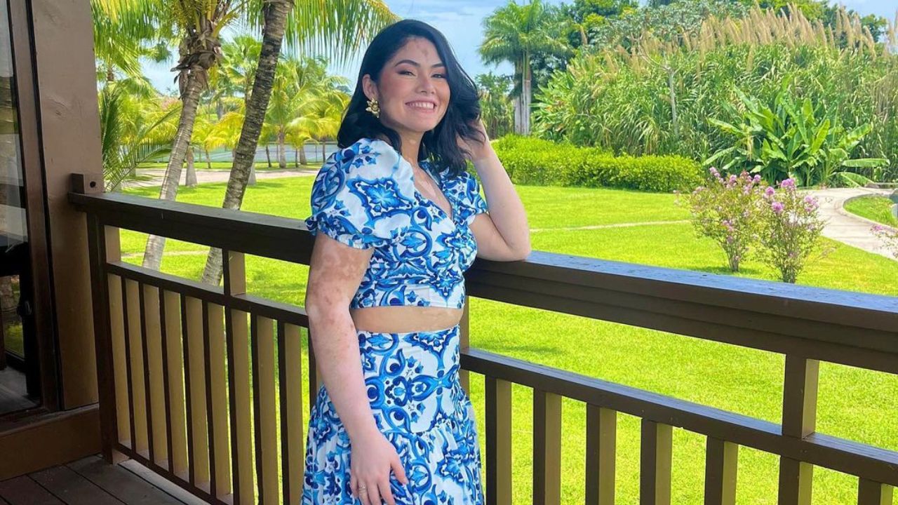 Imagen Principal de Nota: Michelle Enamorado: Joven con vitíligo busca ser Miss Honduras y romper estereotipos