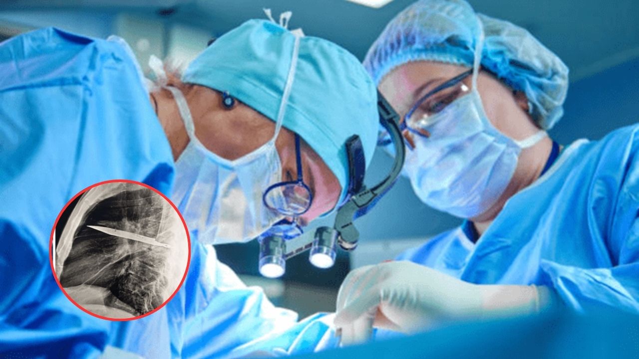 Vivió 8 años con un cuchillo en el pecho sin saberlo: el increíble caso médico
