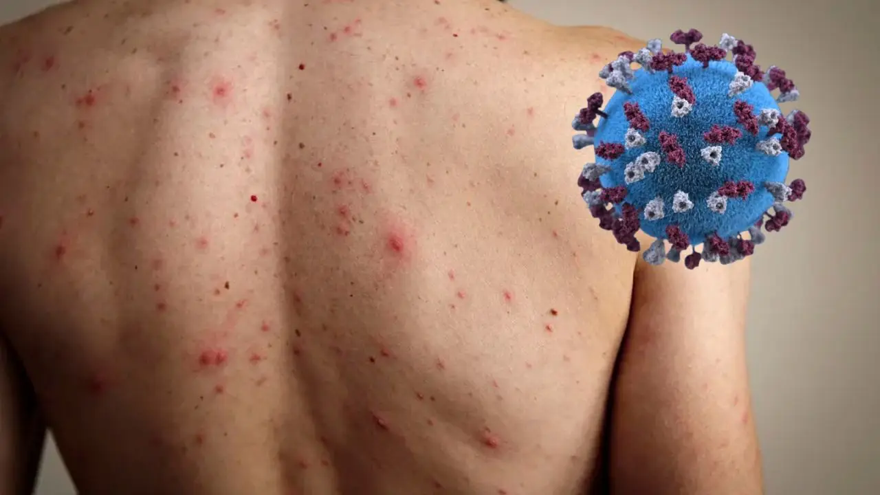 Sarampión: qué síntomas causa y cómo protegerse