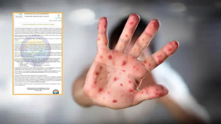 Imagen Principal de Nota: Ponen en cuarentena a hondureños expuestos al sarampión: ¿qué sucedió?