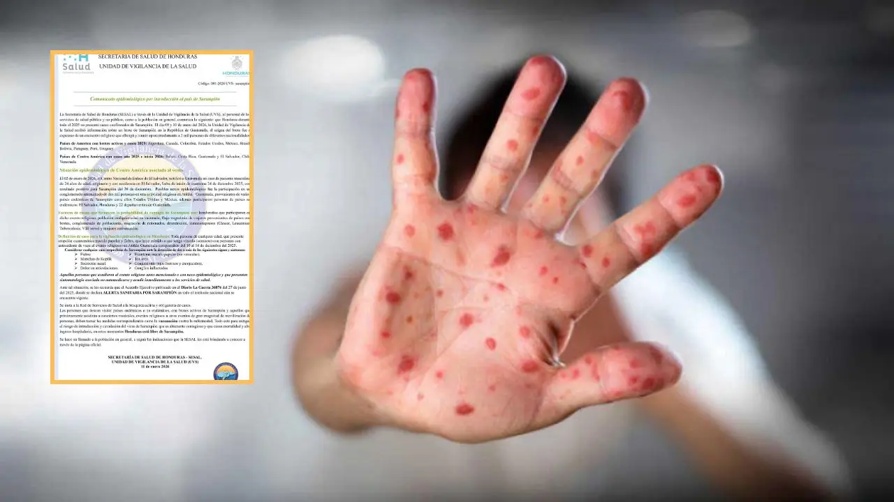 Ponen en cuarentena a hondureños expuestos al sarampión: ¿qué sucedió?