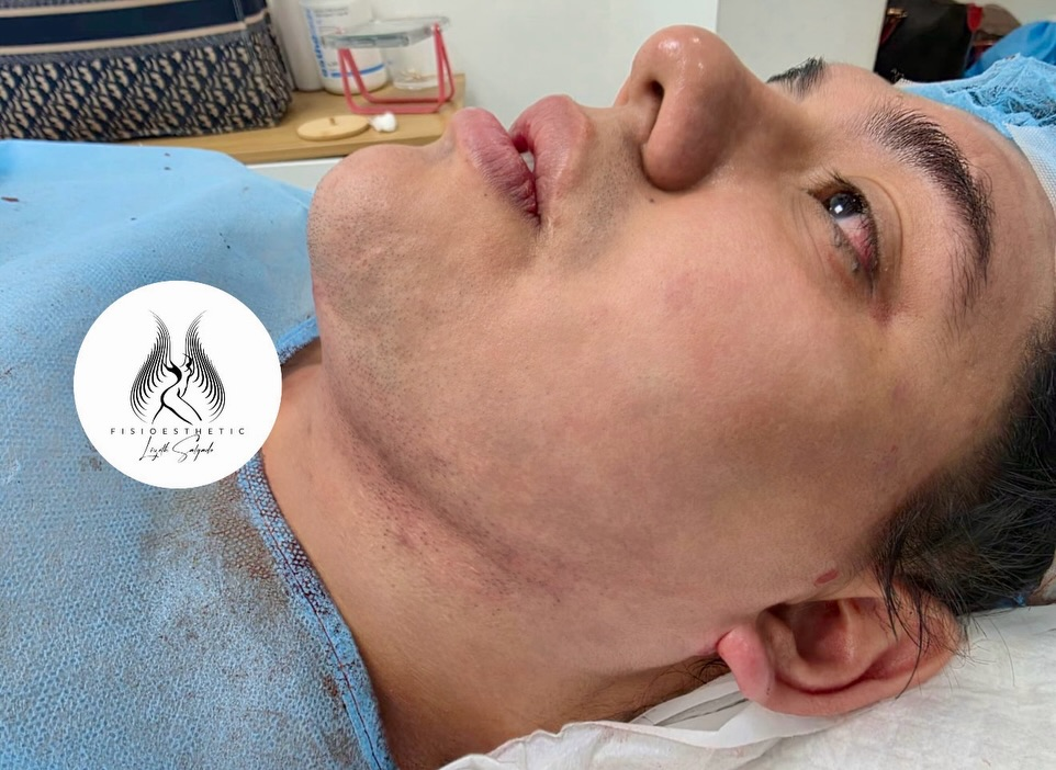 sandrez en su operacion 