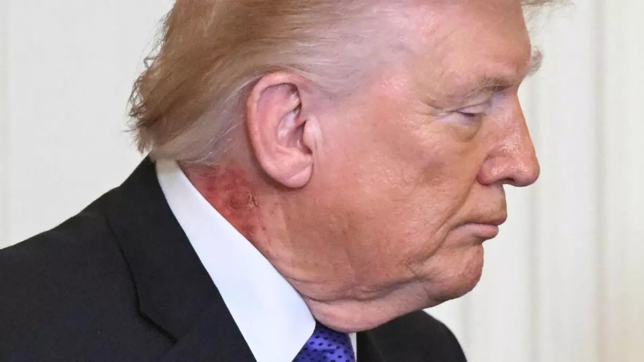Imagen Principal de Nota: ¿Qué tiene Donald Trump en el cuello? Su médico responde