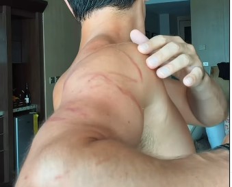 Picadura de agua mala