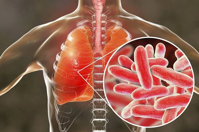 Imagen ilustrativa de cuerpo humano con enfermedad de legionela