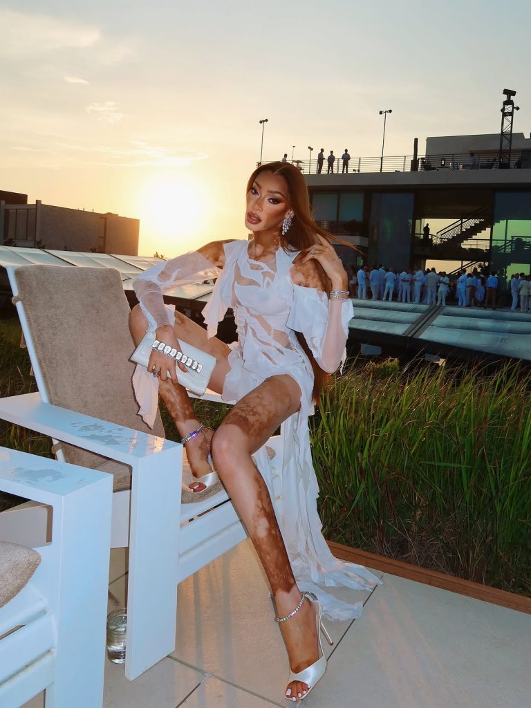 Winnie Harlow uno de los famosos con vitíligo