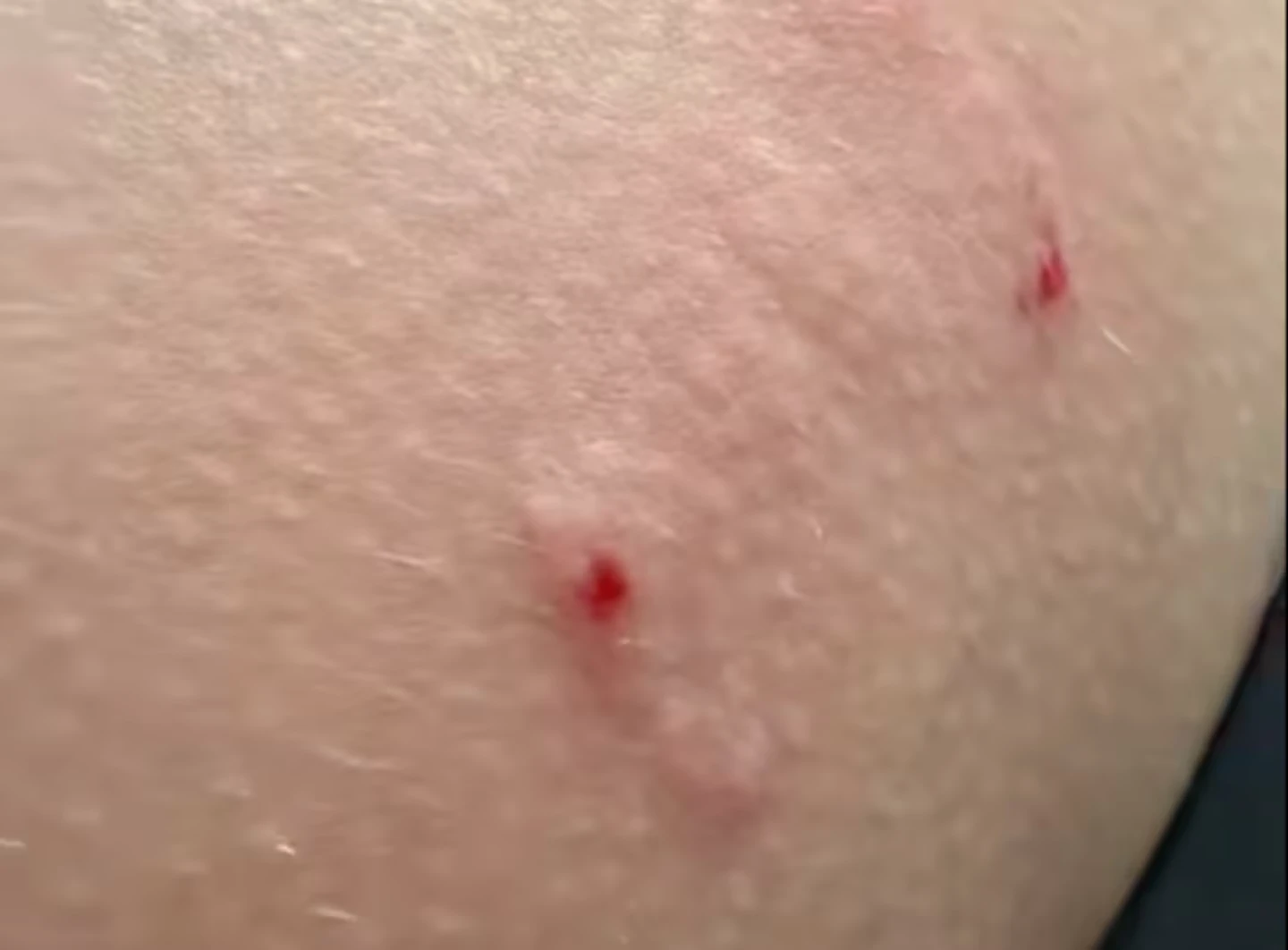 Imagen de mordida en glúteo de Cynthia Benítez